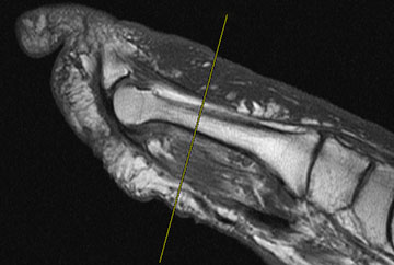 short axis-sag